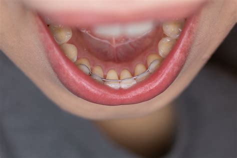 permanent braces for teeth